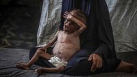 Palestinian baby in Gaza suffering from malnutrition at risk of death