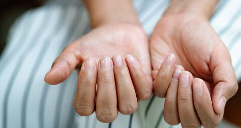 brittle damaged nails after using shellac or gel-lacquer